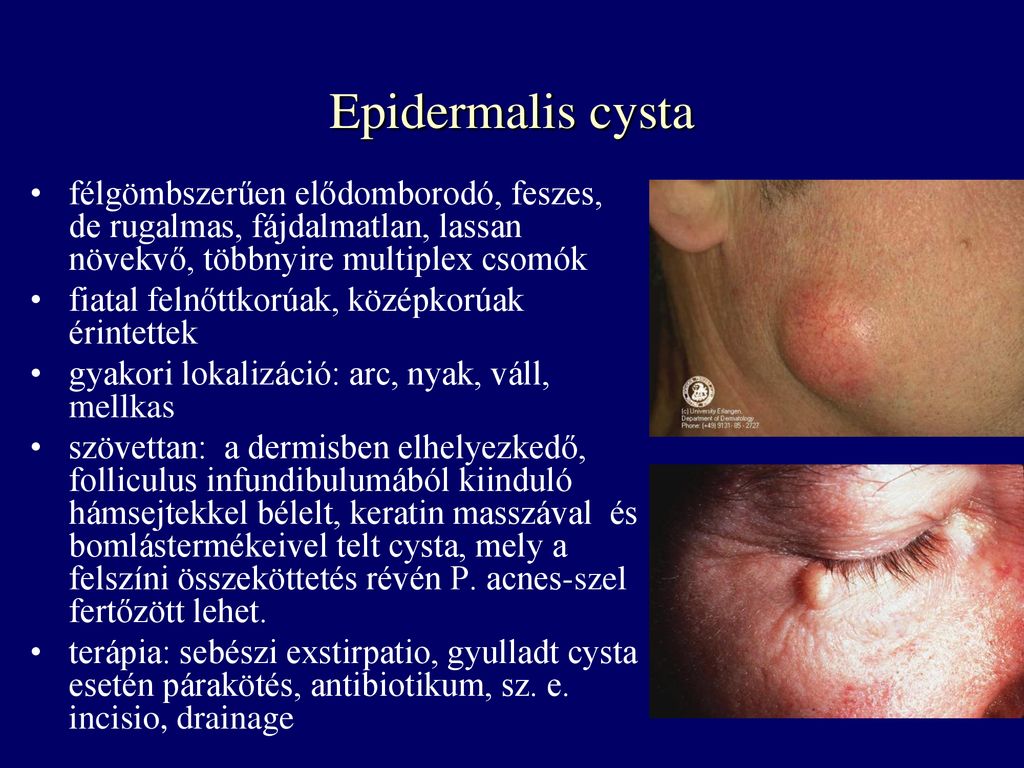 Epidermalis cysta félgömbszerűen elődomborodó, feszes, de rugalmas, fájdalmatlan, lassan növekvő, többnyire multiplex csomók.