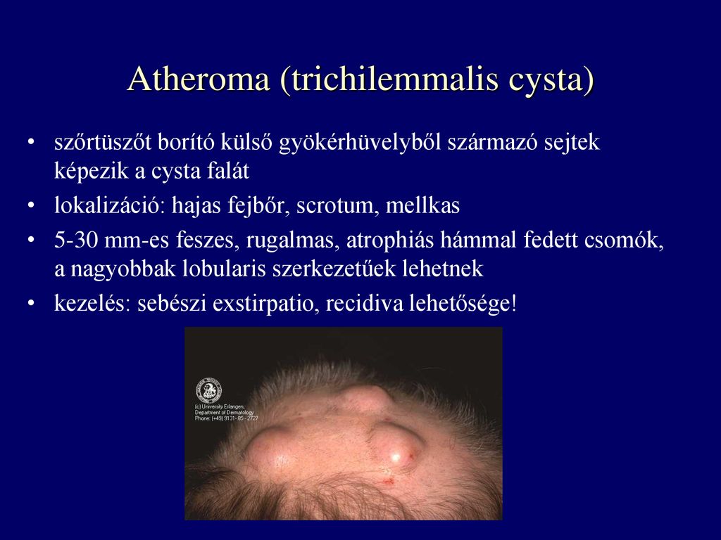 Atheroma (trichilemmalis cysta)