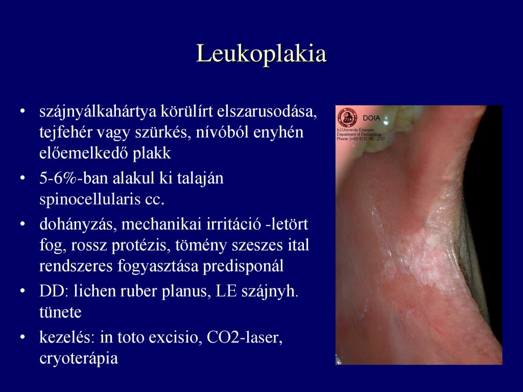 Leukoplakia szájnyálkahártya körülírt elszarusodása, tejfehér vagy szürkés, nívóból enyhén előemelkedő plakk.