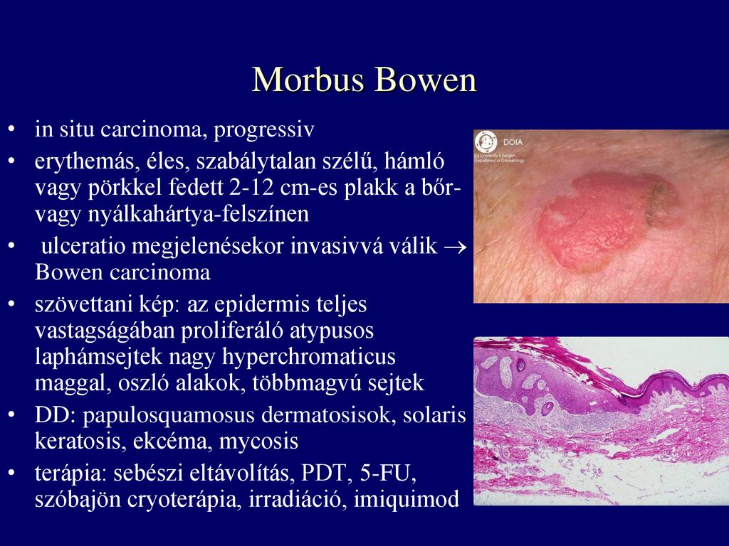Morbus Bowen in situ carcinoma, progressiv