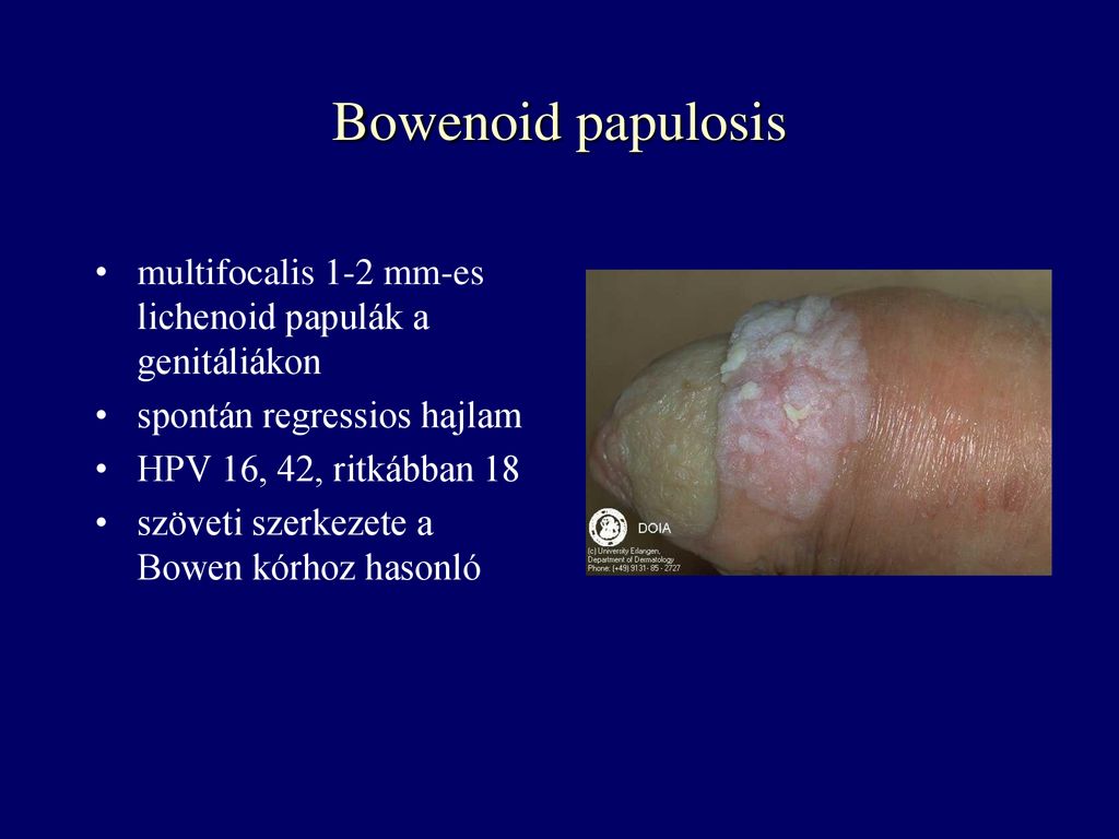 Bowenoid papulosis multifocalis 1-2 mm-es lichenoid papulák a genitáliákon. spontán regressios hajlam.