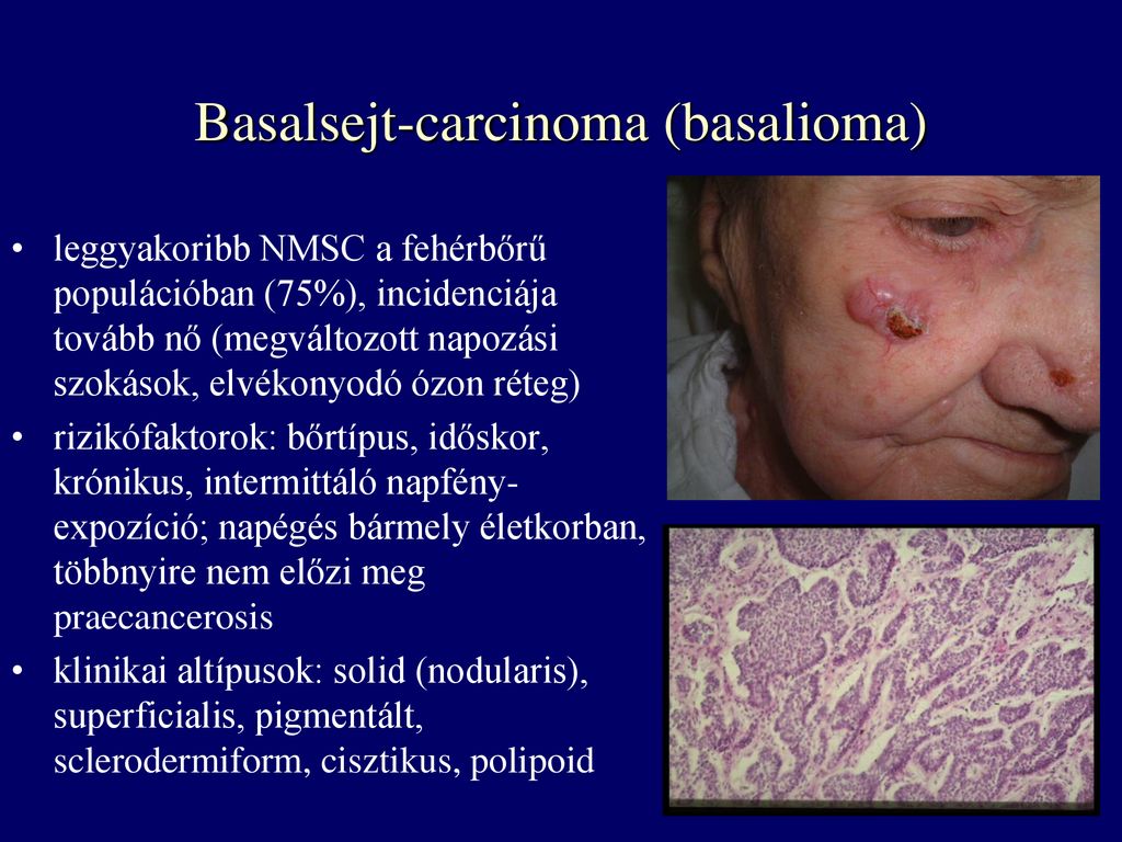 Basalsejt-carcinoma (basalioma)