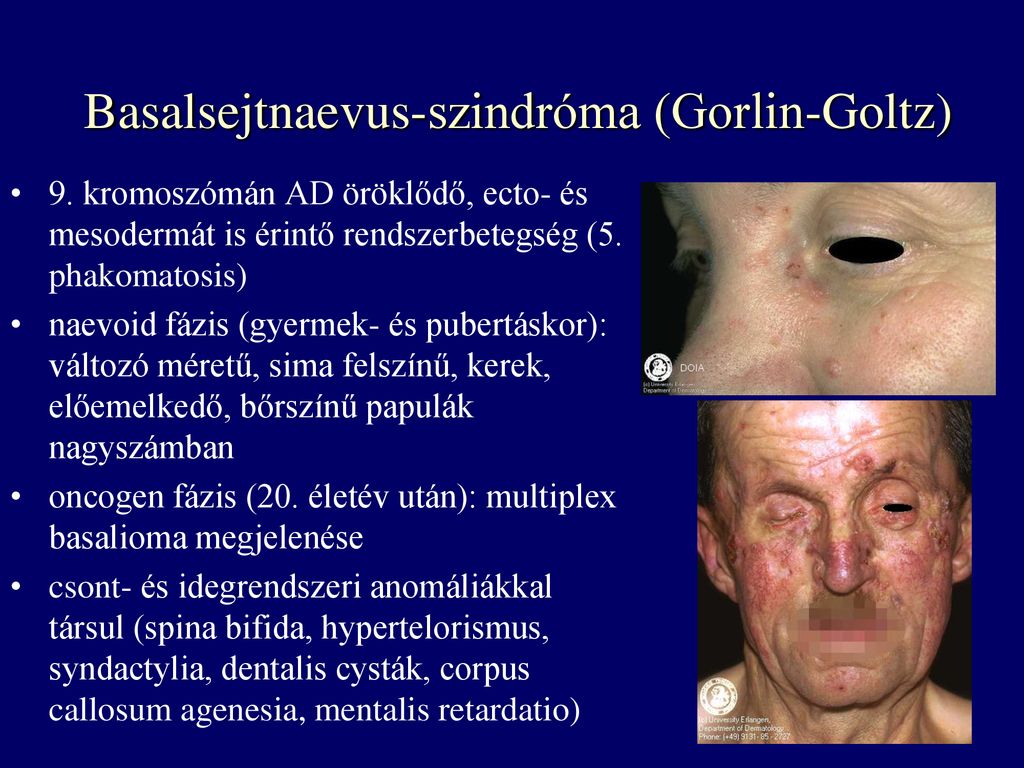 Basalsejtnaevus-szindróma (Gorlin-Goltz)