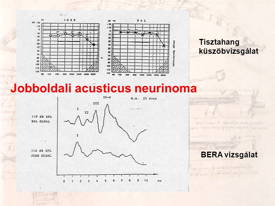 Jobboldali acusticus neurinoma