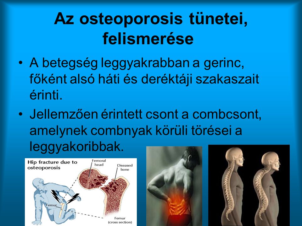Az osteoporosis tünetei, felismerése