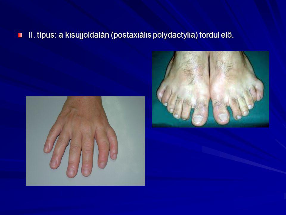 * Összenőtt lábujjak (Betegségek) - Meghatározás - Online Lexikon