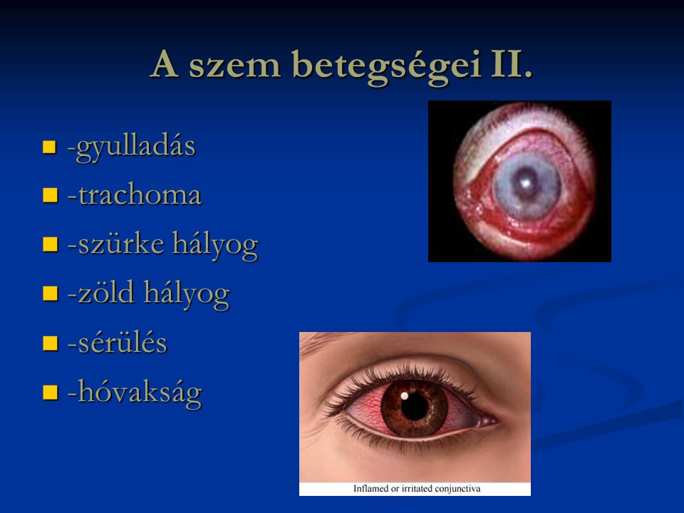 A szem betegségei II. -trachoma -szürke hályog -zöld hályog -sérülés