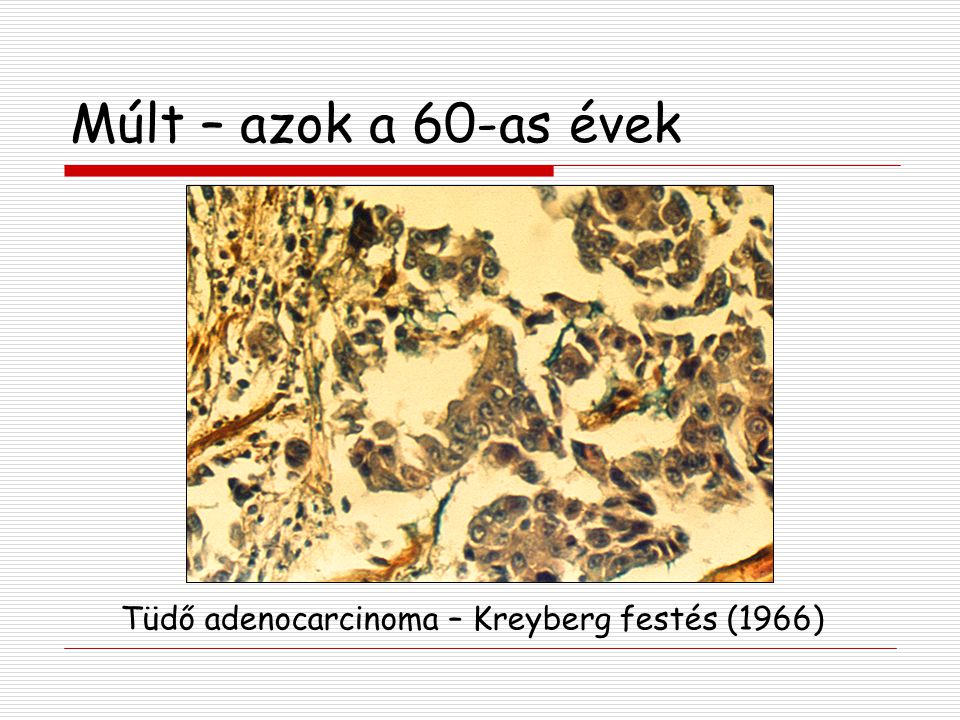 Tüdő adenocarcinoma – Kreyberg festés (1966)