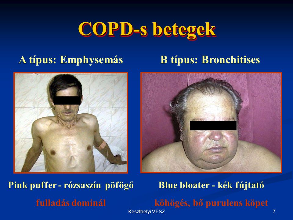 COPD-s betegek A típus: Emphysemás B típus: Bronchitises