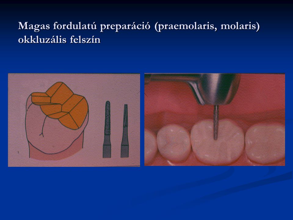 Magas fordulatú preparáció (praemolaris, molaris) okkluzális felszín