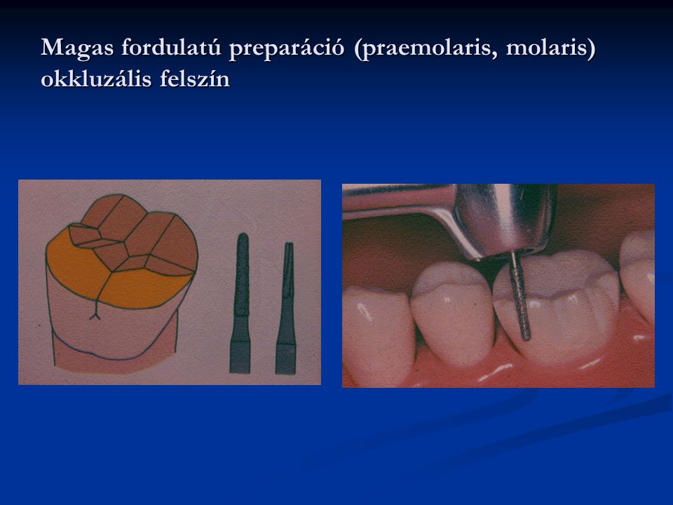 Magas fordulatú preparáció (praemolaris, molaris) okkluzális felszín
