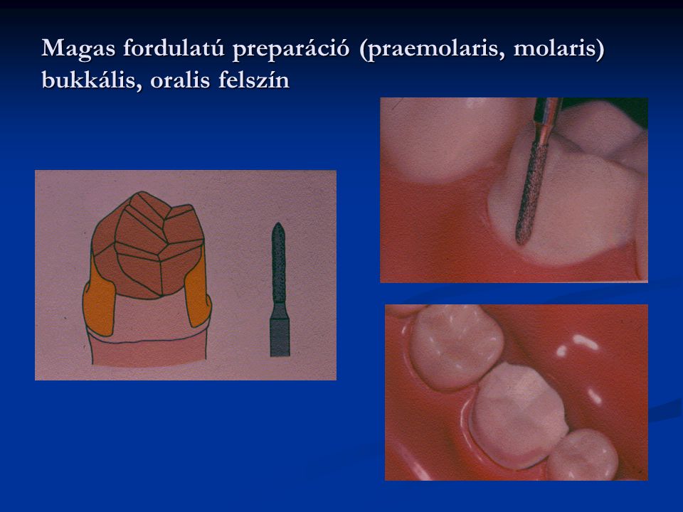 Magas fordulatú preparáció (praemolaris, molaris) bukkális, oralis felszín