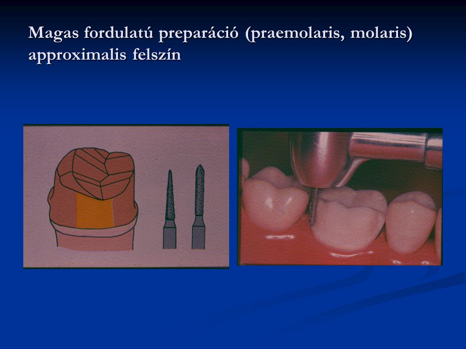 Magas fordulatú preparáció (praemolaris, molaris) approximalis felszín