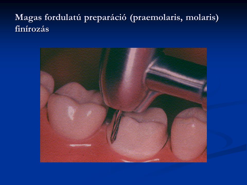 Magas fordulatú preparáció (praemolaris, molaris) finírozás