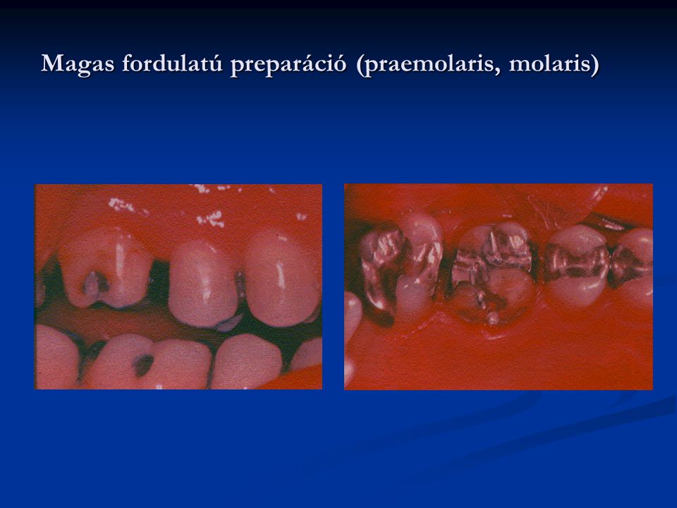 Magas fordulatú preparáció (praemolaris, molaris)
