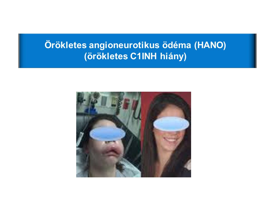 Örökletes angioneurotikus ödéma (HANO) (örökletes C1INH hiány)