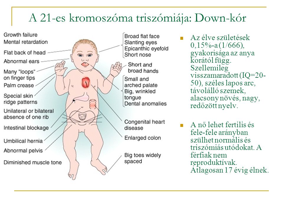 A 21-es kromoszóma triszómiája: Down-kór
