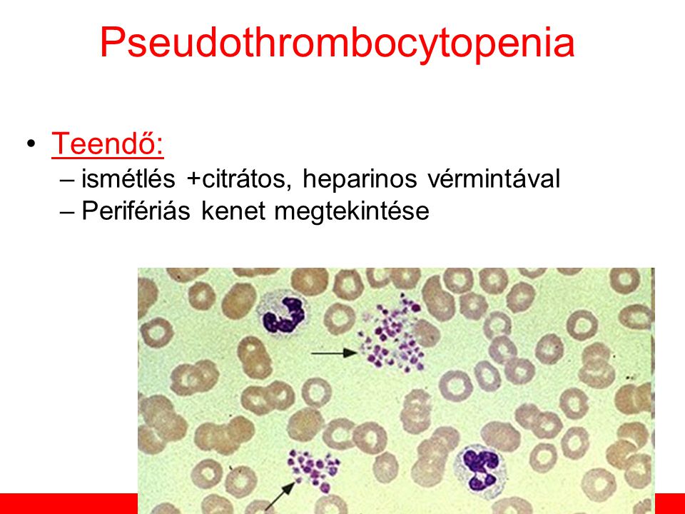 Pseudothrombocytopenia