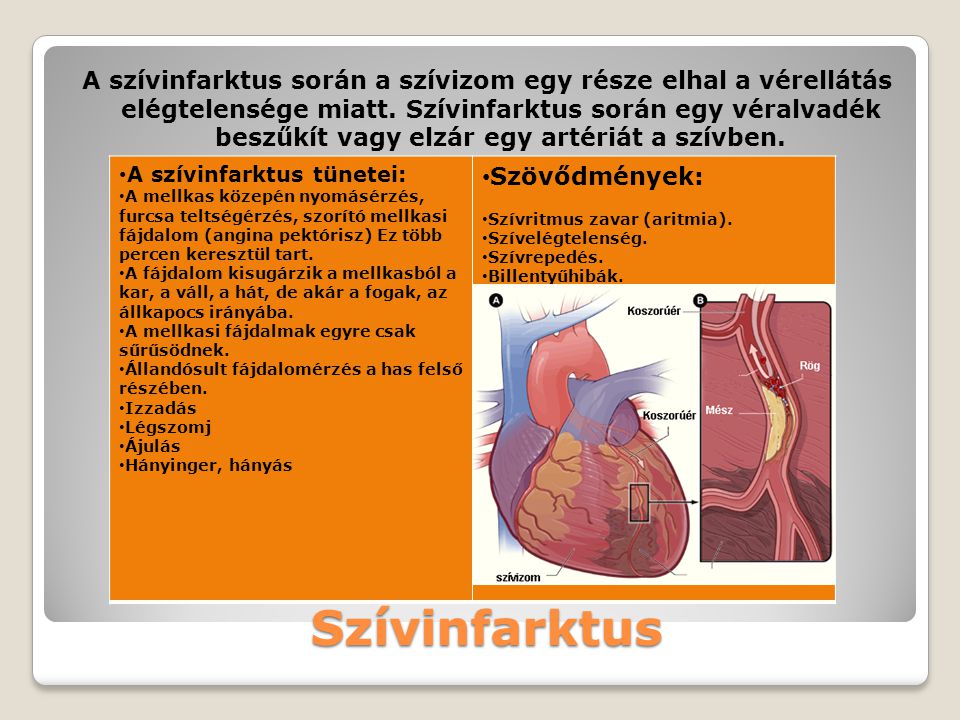 A szívinfarktus során a szívizom egy része elhal a vérellátás elégtelensége miatt. Szívinfarktus során egy véralvadék beszűkít vagy elzár egy artériát a szívben.