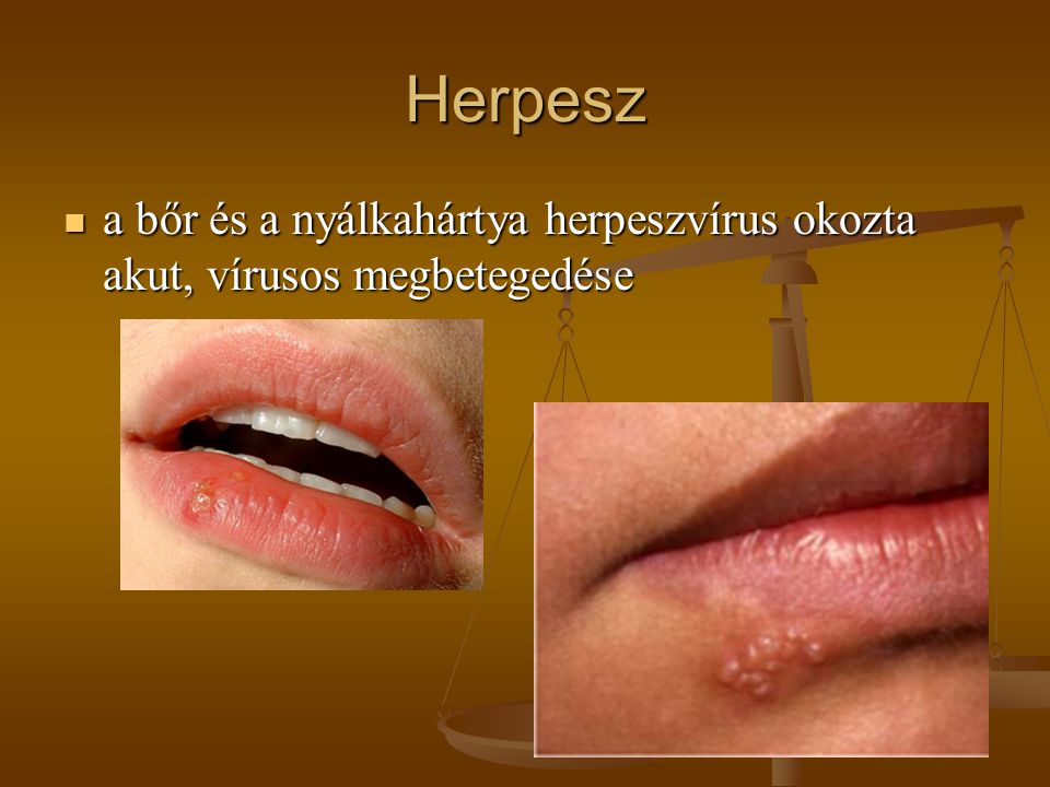 Herpesz a bőr és a nyálkahártya herpeszvírus okozta akut, vírusos megbetegedése