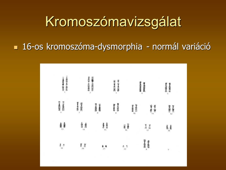 Kromoszómavizsgálat 16-os kromoszóma-dysmorphia - normál variáció