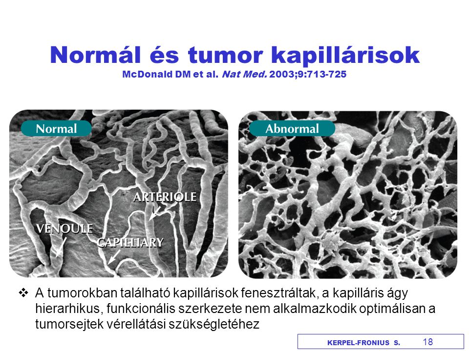 Normál és tumor kapillárisok McDonald DM et al. Nat Med. 2003;9: