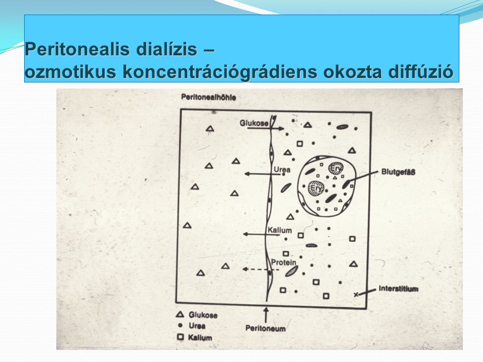 Peritonealis dialízis – ozmotikus koncentrációgrádiens okozta diffúzió