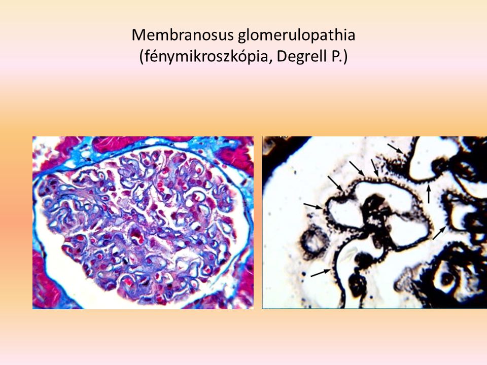 Membranosus glomerulopathia (fénymikroszkópia, Degrell P.)