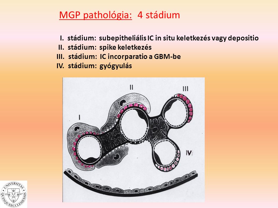 MGP pathológia: 4 stádium