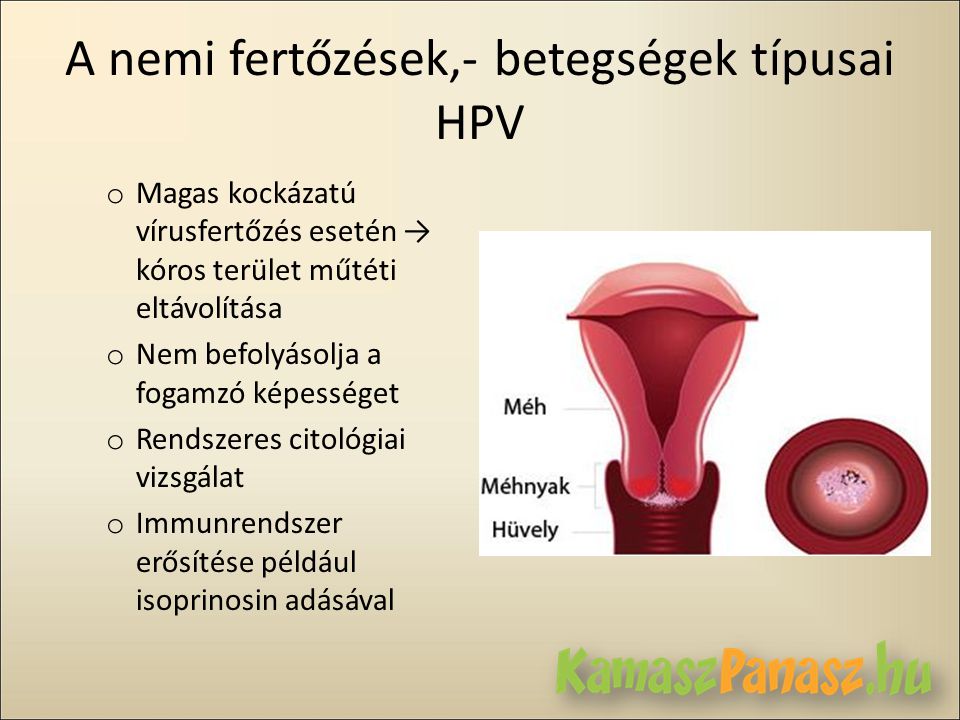 A nemi fertőzések,- betegségek típusai HPV