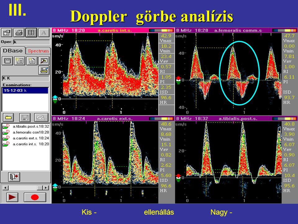 Doppler görbe analízis
