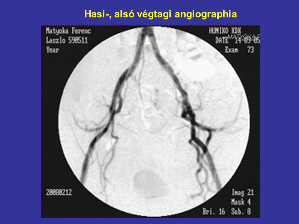 Hasi-, alsó végtagi angiographia