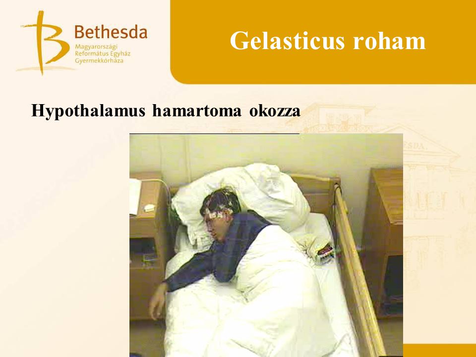Gelasticus roham Hypothalamus hamartoma okozza