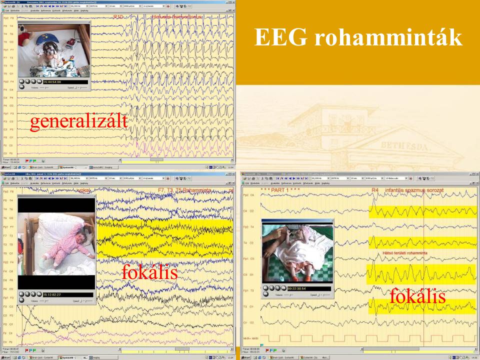EEG rohamminták generalizált fokális fokális