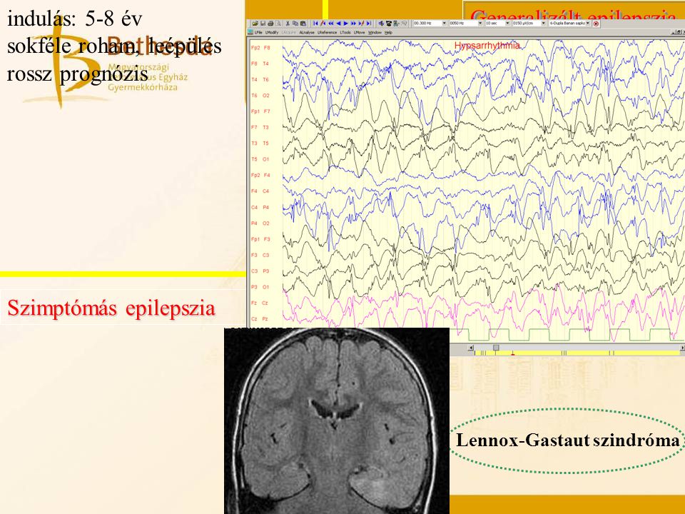 Generalizált epilepszia