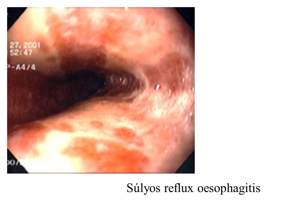 Súlyos reflux oesophagitis