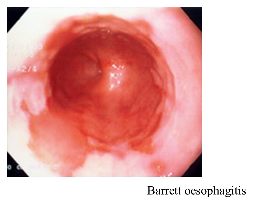 Barrett oesophagitis