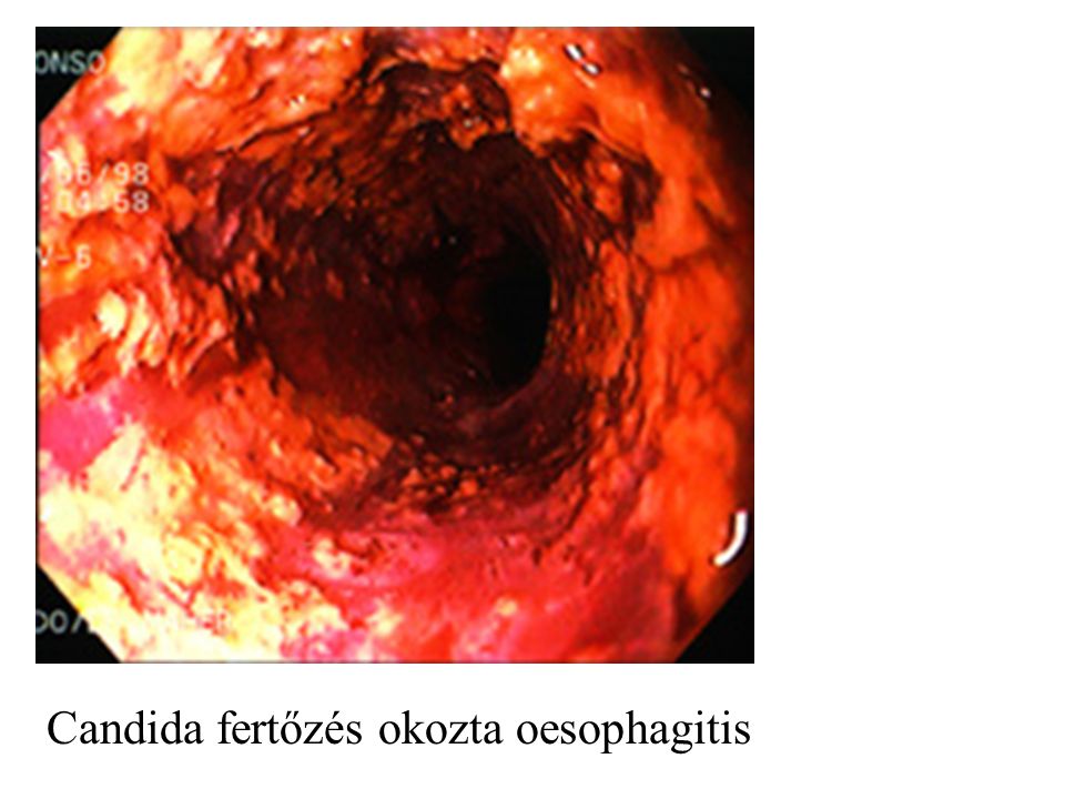 Candida fertőzés okozta oesophagitis