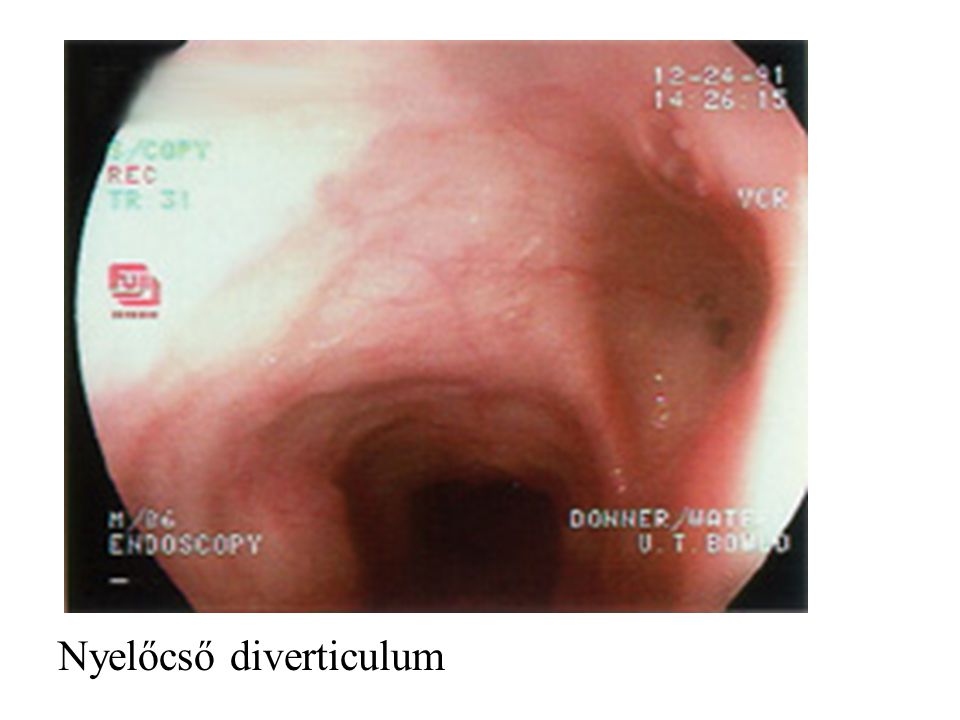 száj nyelőcső divertikulum