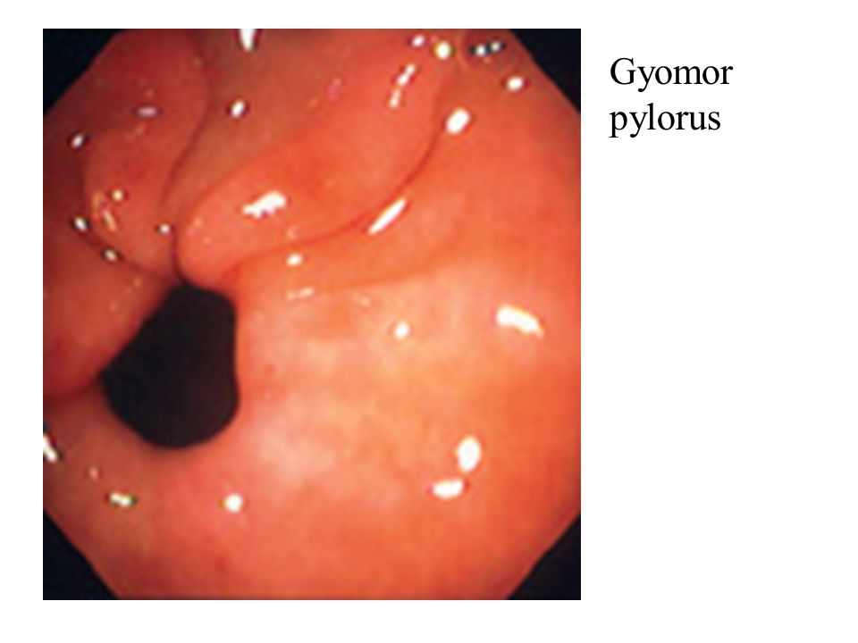 Gyomor pylorus