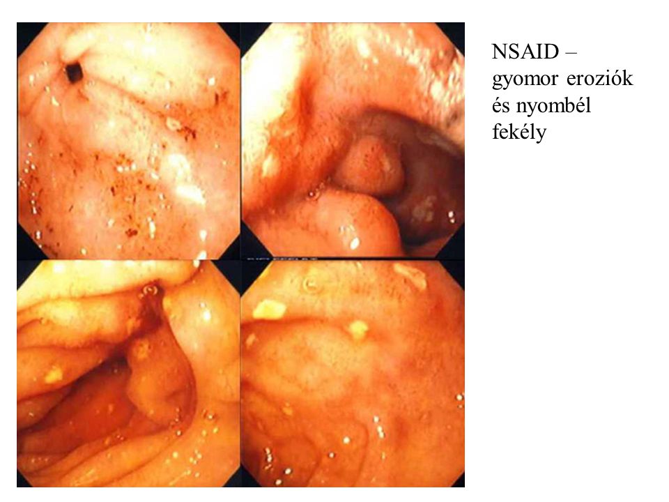NSAID – gyomor eroziók és nyombél fekély