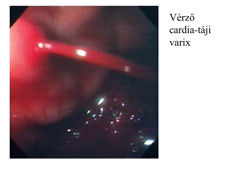 Vérző cardia-táji varix