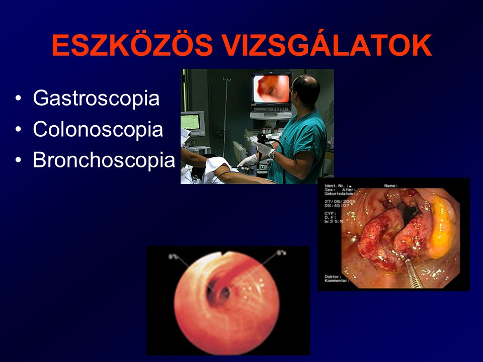 ESZKÖZÖS VIZSGÁLATOK Gastroscopia Colonoscopia Bronchoscopia