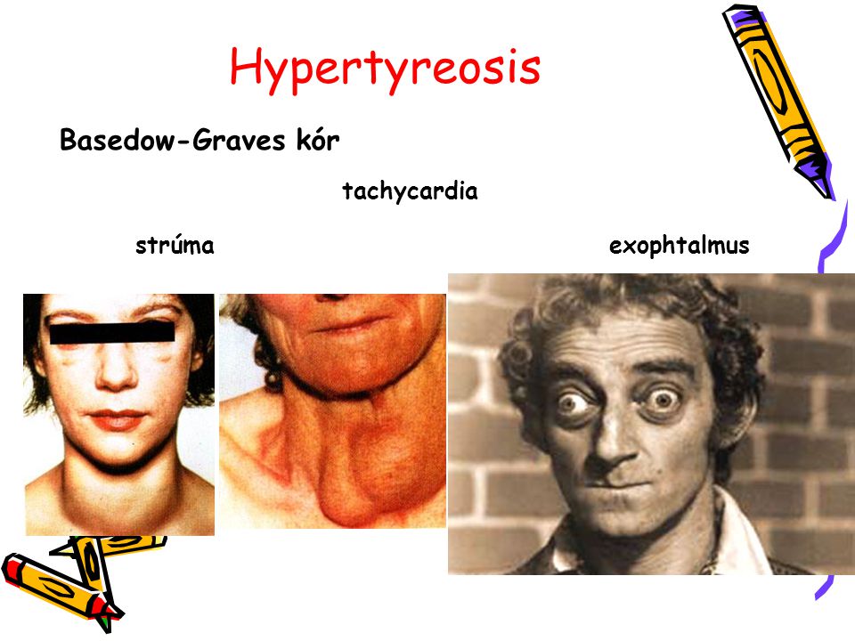 Hypertyreosis Basedow-Graves kór tachycardia strúma exophtalmus