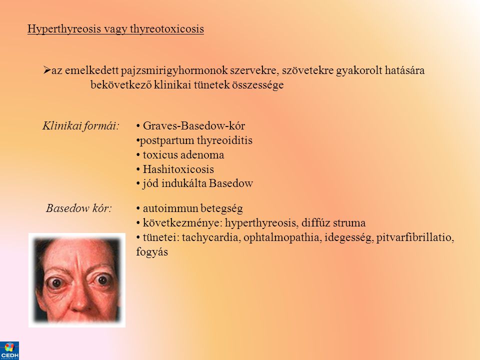 Hyperthyreosis vagy thyreotoxicosis