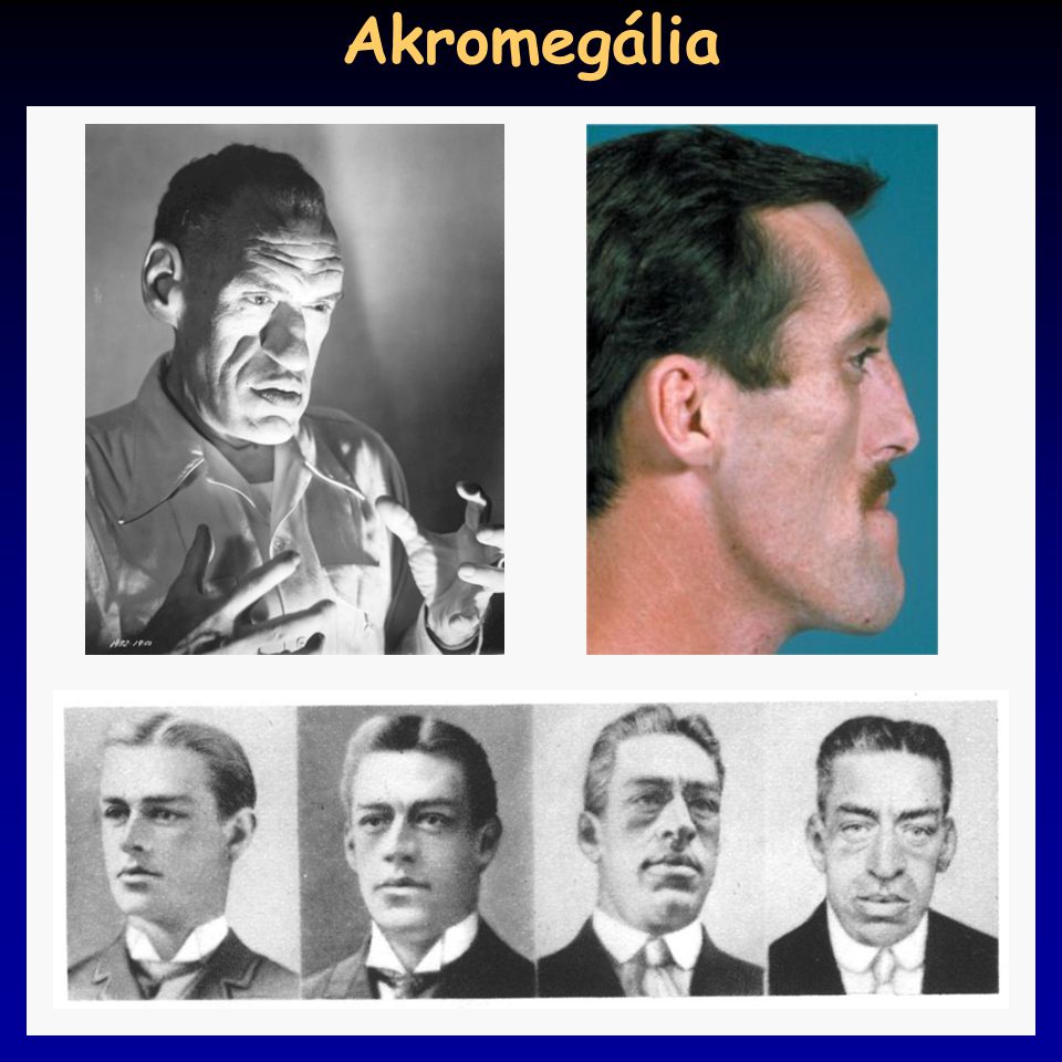 Akromegália