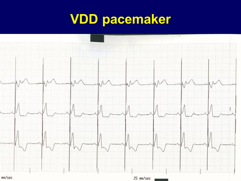 VDD pacemaker