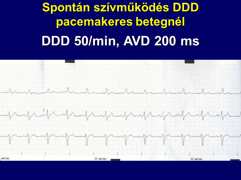 Spontán szívműködés DDD pacemakeres betegnél