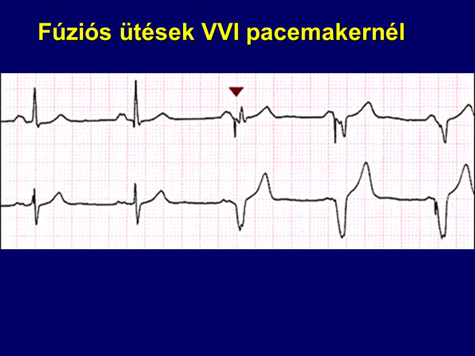 Fúziós ütések VVI pacemakernél