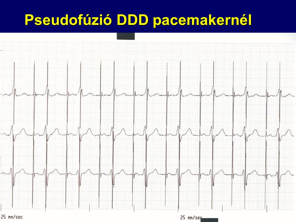 Pseudofúzió DDD pacemakernél